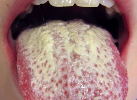 a white tongue