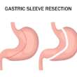 What happens if you eat solid food after gastric sleeve