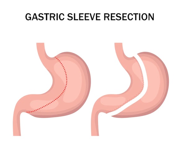 gastric sleeve 
