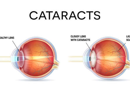 Cataract Surgery Explained