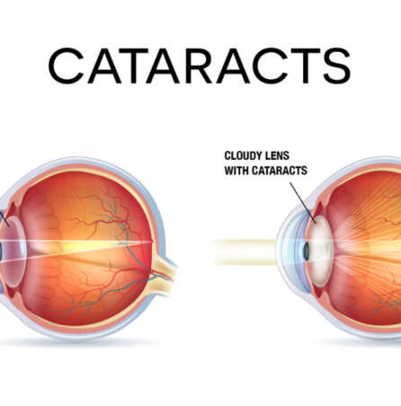 Cataract Surgery Explained