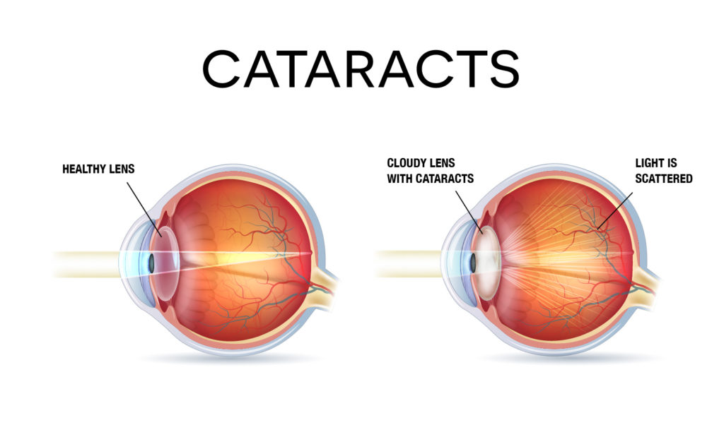Cataract Surgery Explained